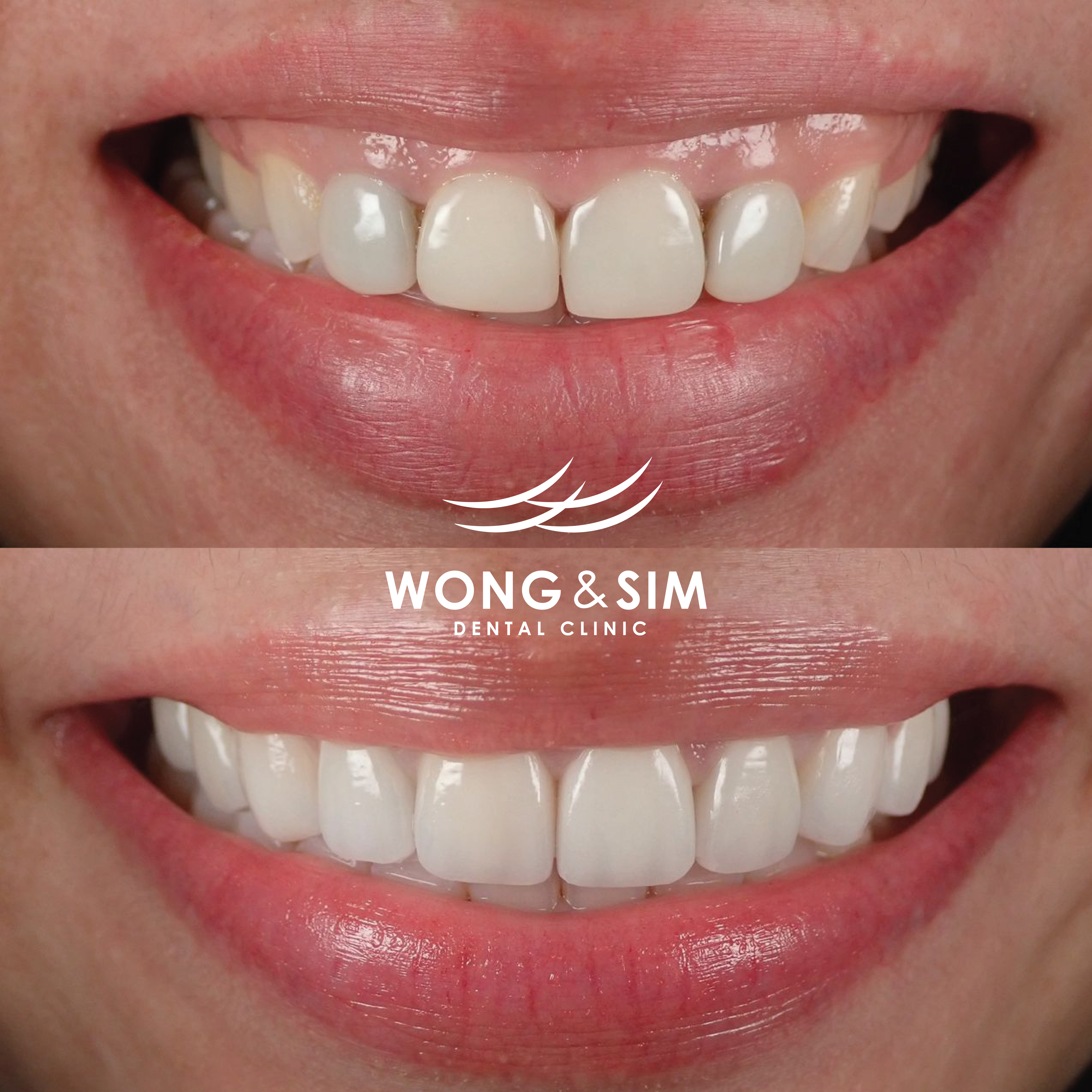 Patient 7 - Dental Implants Before and After